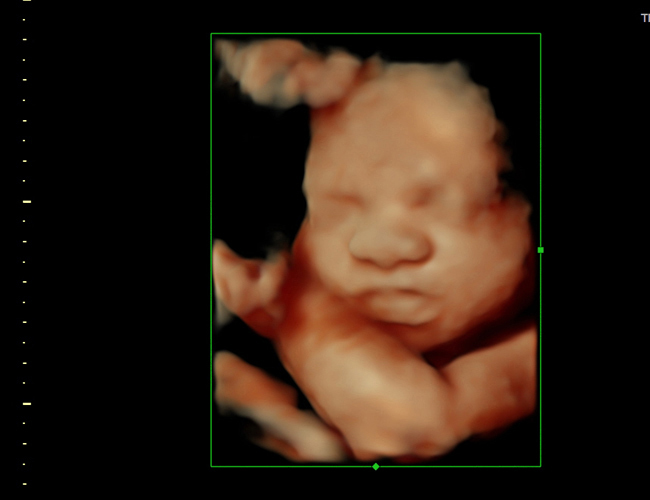 3D ultrasound image at 29 weeks